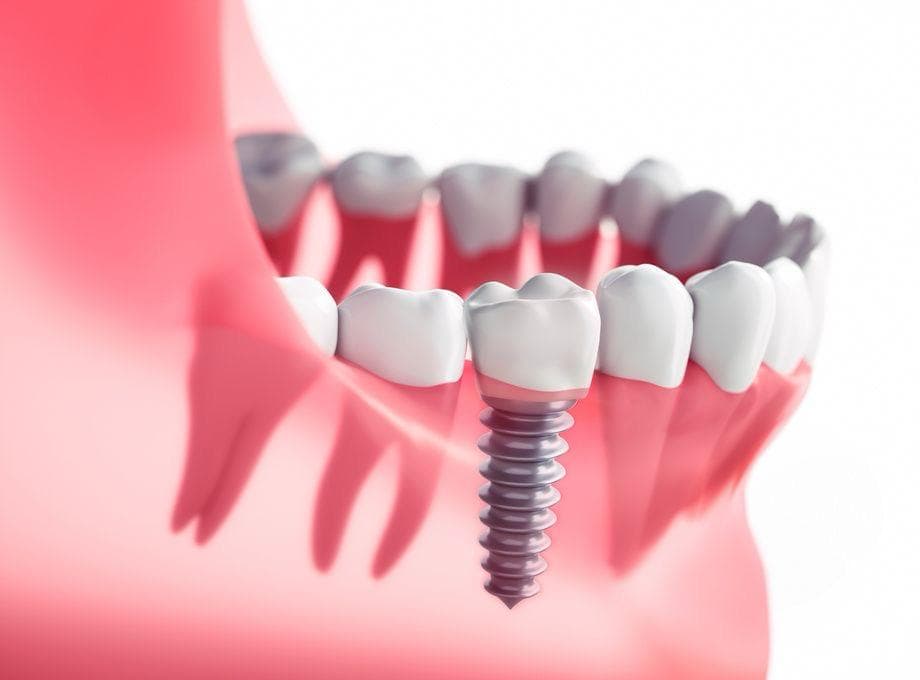 Dental Implants