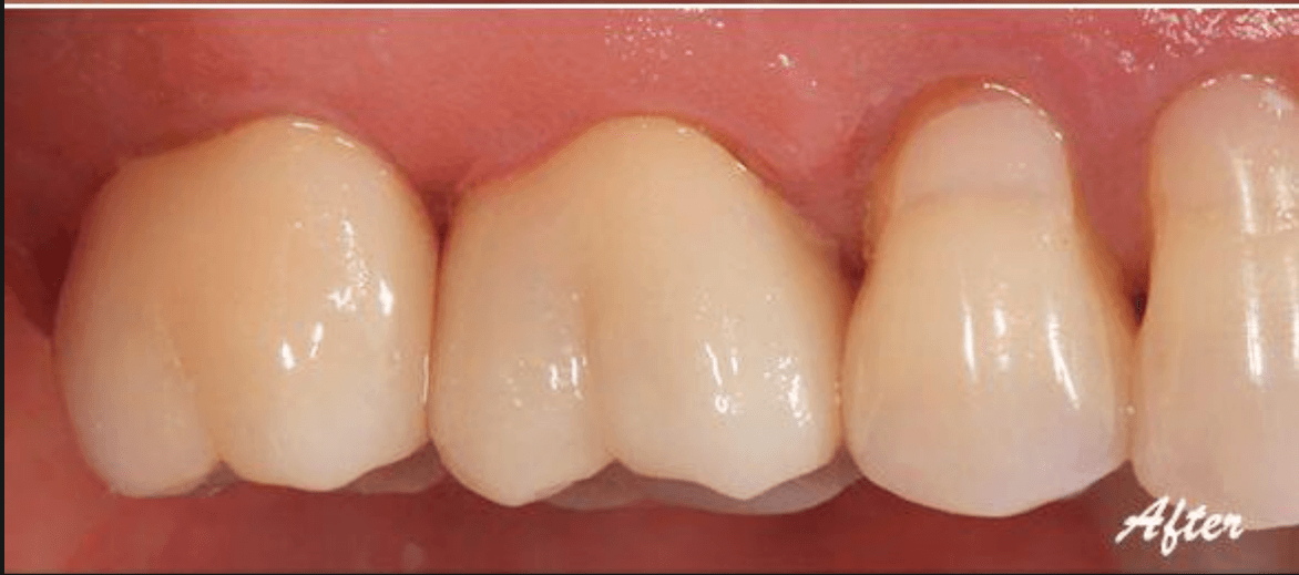 Dental Crowns - After