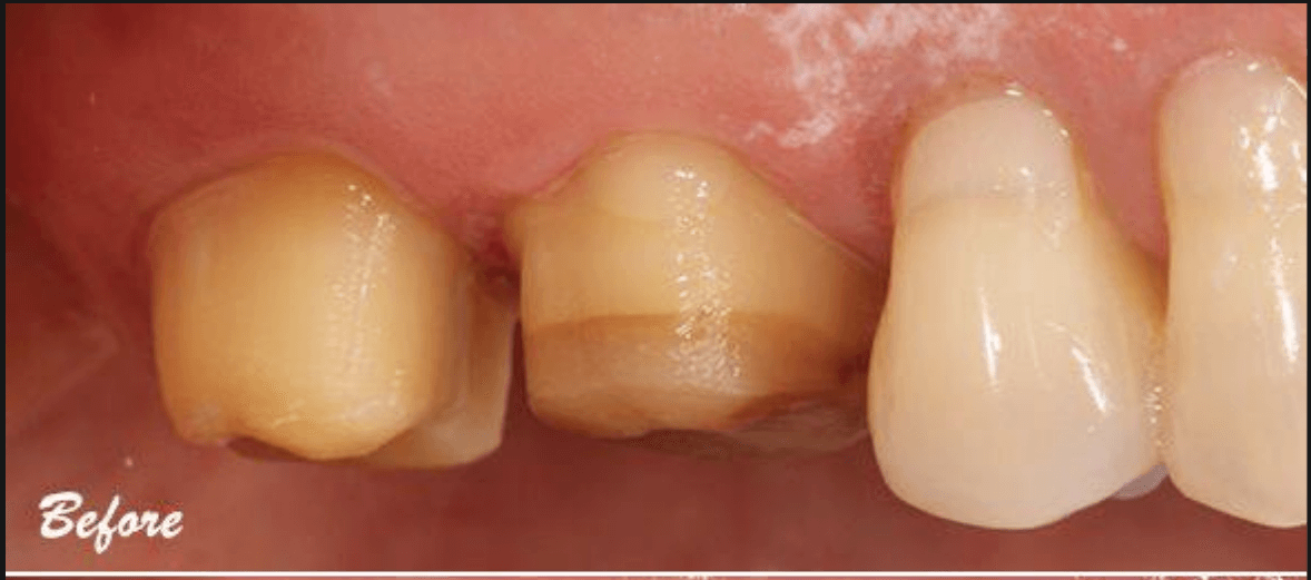 Dental Crowns - Before