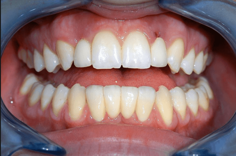 Dental Implants - After