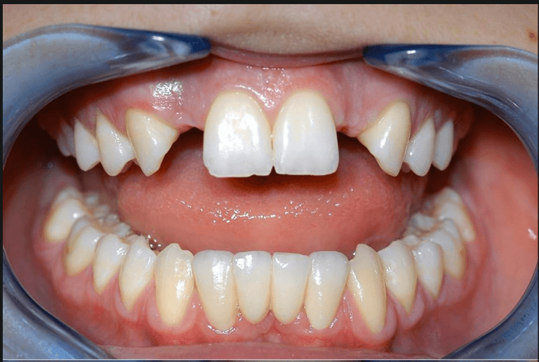 Dental Implants - Before