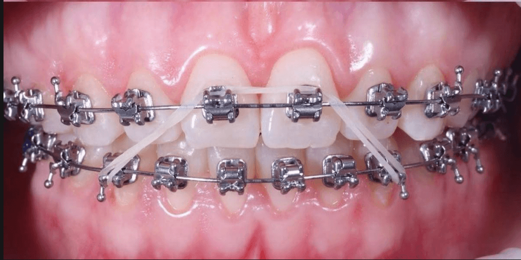 Orthodontics - After