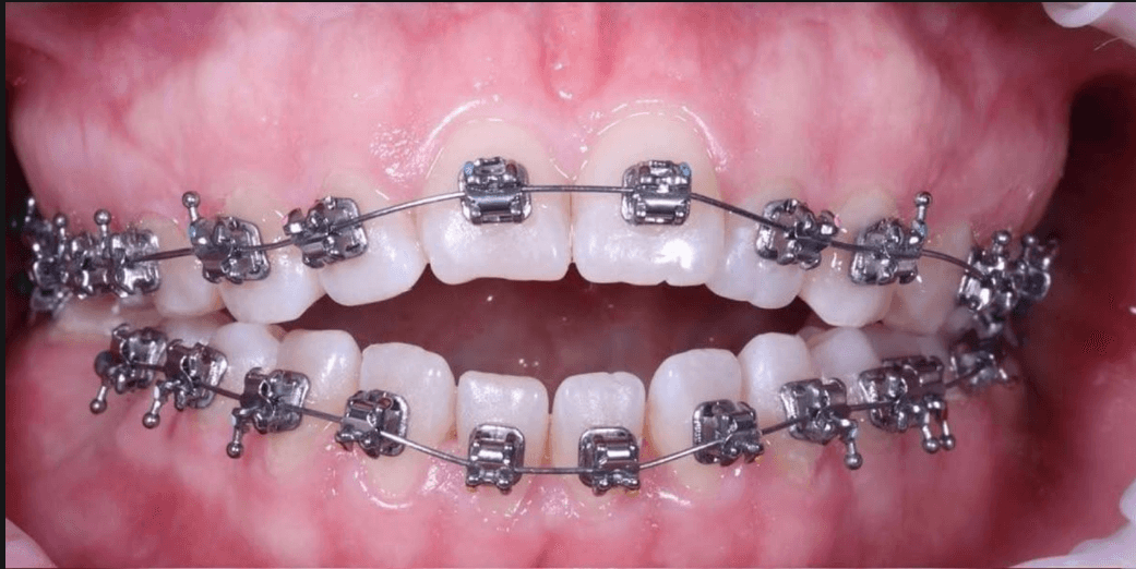 Orthodontics - Before