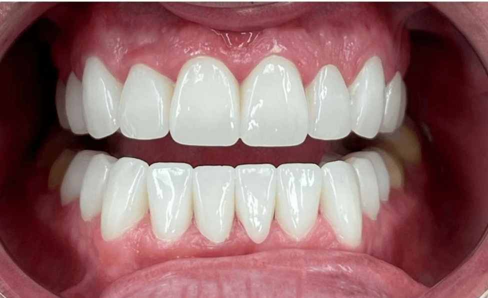 Dental Veneers - After