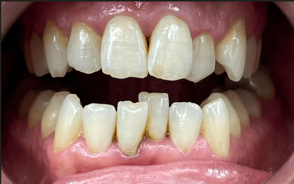 Dental Veneers - Before
